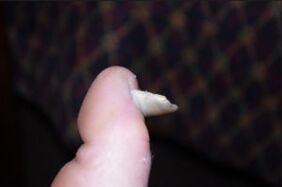 Symptoms of fungus on the nails