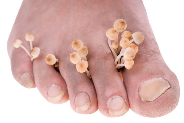 fungus on the legs symptoms