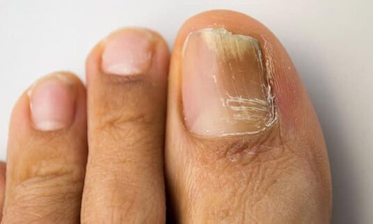 Distal-lateral type of damage with onychomycosis on the legs