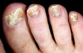 symptoms of toenail fungus