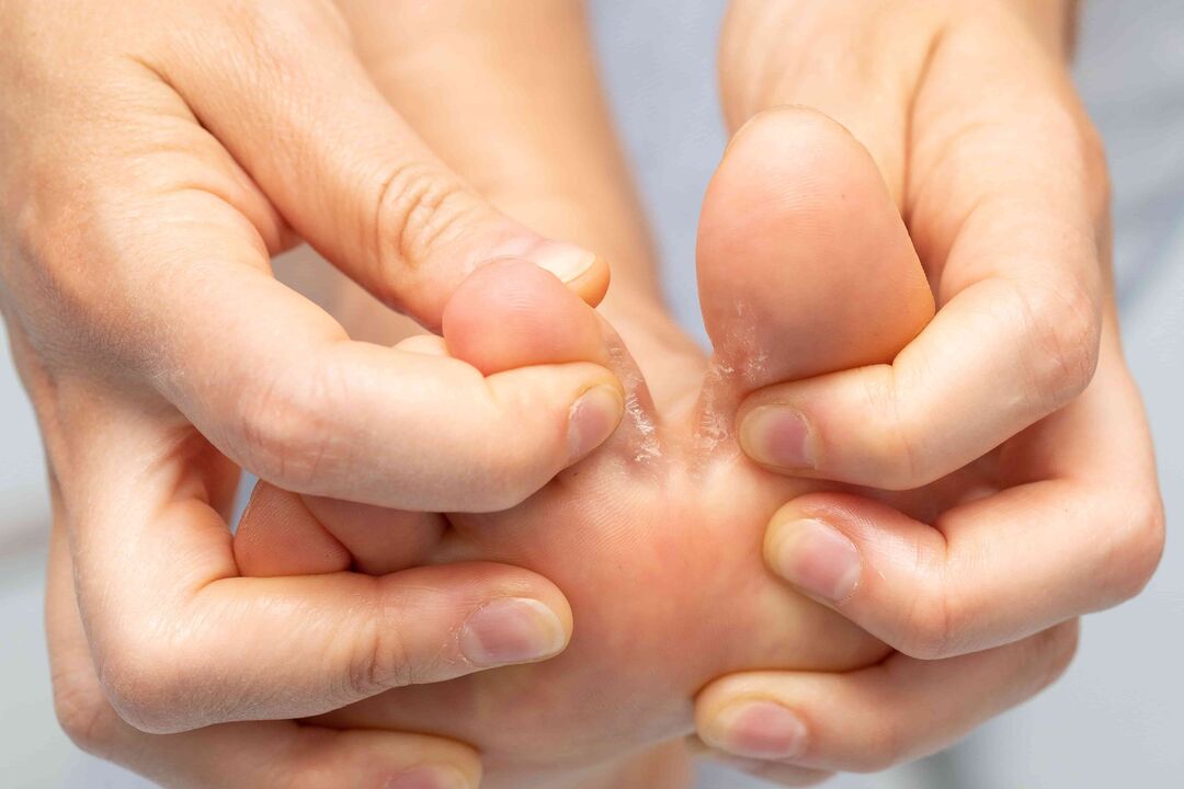 fungus between the toes and its treatment with zxcvbnmqwert cream